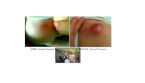 SEBACEOUS CYST TREATMENT