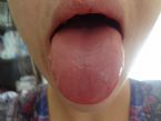 swelling tongue, see the edge got teeth marks