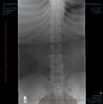 CR LUMBAR SPINE 2 OR 3 VWS 0001 edit ... (Click to enlarge)