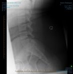 CR LUMBAR SPINE 2 OR 3 VWS 0002edit ... (Click to enlarge)