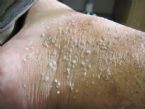 Stucco Keratosis on Right ankle ... (Click to enlarge)