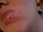 Worst Cold Sore Ever ... (Click to enlarge)