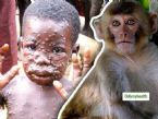 Monkeypox