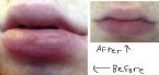 lip peeling cured healed completetly after 25 yrs back