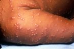 smallpox large image