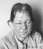 smallpox variola child