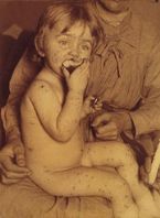 smallpox variola child2