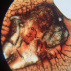 Parasite Skin Cyst Larva Worm Fluke Morgellons Disease - What Is This?