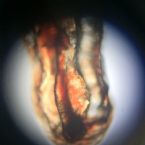 Microscopic Photo Parasite Skin Cyst Larva Worm Fluke Morgellons Disease - What Is This? 4