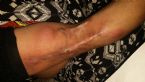 Arm symptoms, Ashs mystery skin disorder