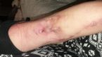 Arm symptoms, Ashs mystery skin disorder 2