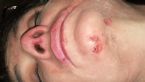 Chin symptoms, Ashs mystery skin disorder