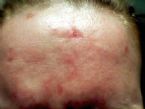 PARASITES!? Picture of my forehead uploaded.