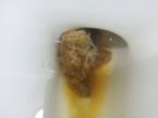 clear noodle substance attached to human feces ... (Click to enlarge)