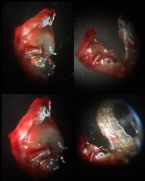 Skin Parasite Sample. Flat Curled ... (Click to enlarge)