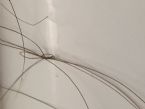 A knot caused by the parasite that caused 80% of my hair to fall out ... (Click to enlarge)