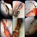 Ova + Flat Worm, Helminth Larvae, Threadworm, Demodex ? More Unidentified Skin Parasite Specimens May June 2018 ... (Click to enlarge)