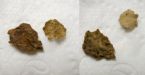 Photos of brown flakes in my poop / feces ... (Click to enlarge)