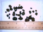 mygallstones1.jpg