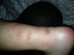 Bites on leg