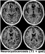 neurocysticercosis ... (Click to enlarge)