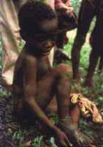 Guinea  worm, People infected with parasite