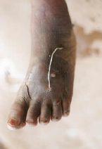 Guinea  worm, People infected with parasite