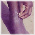 Guinea  worm, People infected with parasite