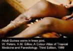 Guinea  worm, People infected with parasite