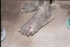 Guinea  worm, People infected with parasite