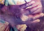 Guinea  worm, People infected with parasite