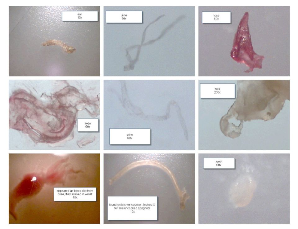 Rare Human Skin Parasites