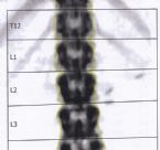 worms in lungs