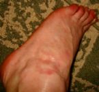 other foot rash same person