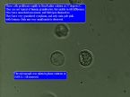 blastocystis in blood