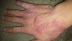 Eczema or parasite?