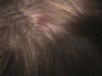 DVC02901sores from scalp fibers