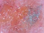 strongyloides stercoralis is morgellons ... (Click to enlarge)