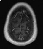 MRI Jun08 20025