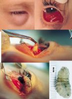 Bot Flies: worm inside human eye