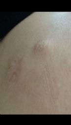 Marks on right buttock