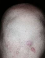 Scalp parasite?