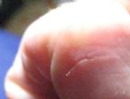 parasite entry wound right pinky finger ... (Click to enlarge)