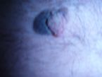 Copy of Picture melanoma 001