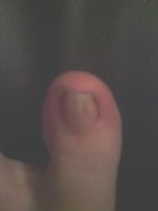 toenail fungus on big toe left foot