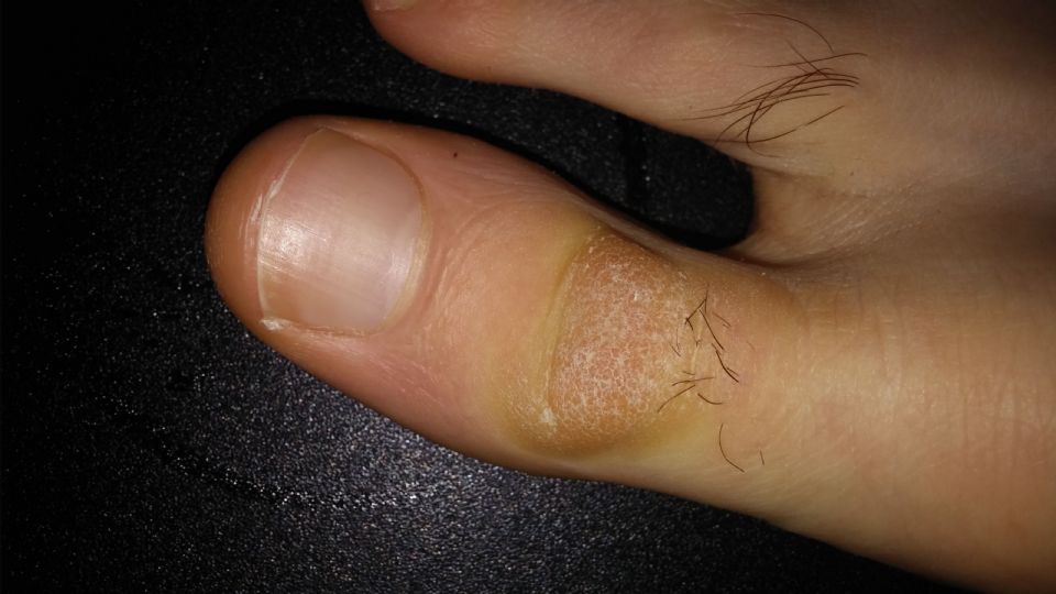 Help Identifying Toe Skin Problem Skin Face 1 5 2016 2295479