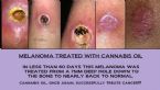 Melanoma treated with cannabis oil