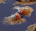 Cancer cell under microscope