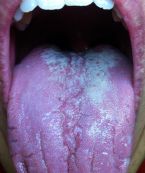 Candida_tongue