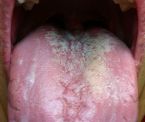 Candida_tongue_2